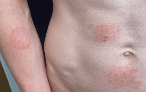 Red, circular rash-like patches on a person’s torso and arm that may be associated with an STI.