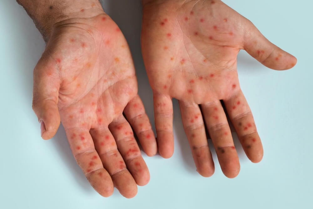 Close-up of two hands showing a red, spotty rash on the palms and fingers, consistent with measles symptoms.